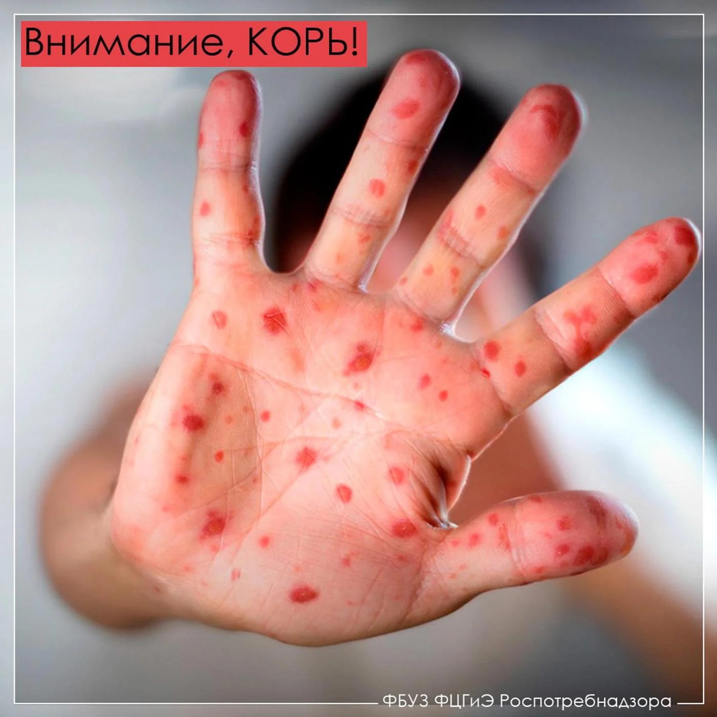 Внимание - корь: памятки пациентам.