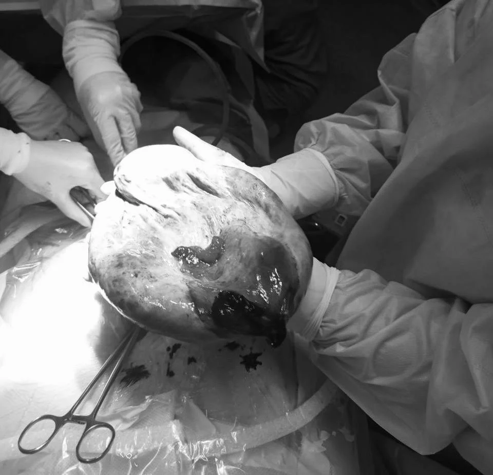 Объемную кисту, содержащую около трех литров жидкости, удалили у 13-летней пациентки