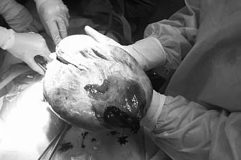 Объемную кисту, содержащую около трех литров жидкости, удалили у 13-летней пациентки