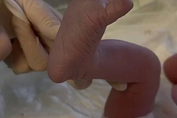 В Перинатальном центре в июле родилось 13 пар двойняшек В Перинатальном центре в июле родилось 13 пар двойняшек